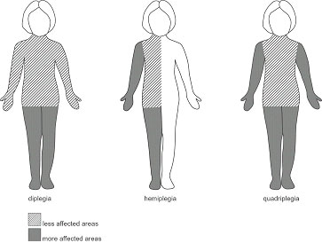 Cerebral Palsy Results