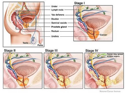 Prostate Cancer Stages