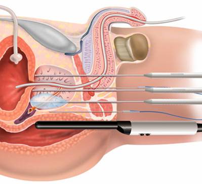 Prostate Cancer treatment